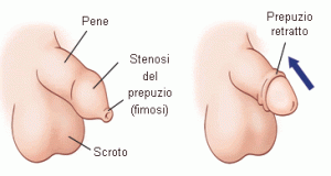 causa fimosi