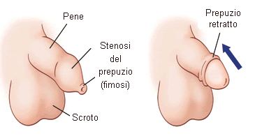 Alternative phimostop Phimosis Stretching